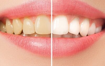 Manchas en los dientes: Causas y tratamientos