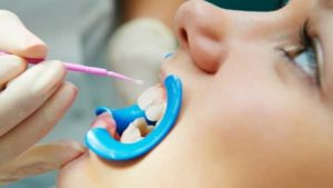selladores dentales para niños