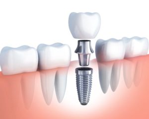 Implantes dentales